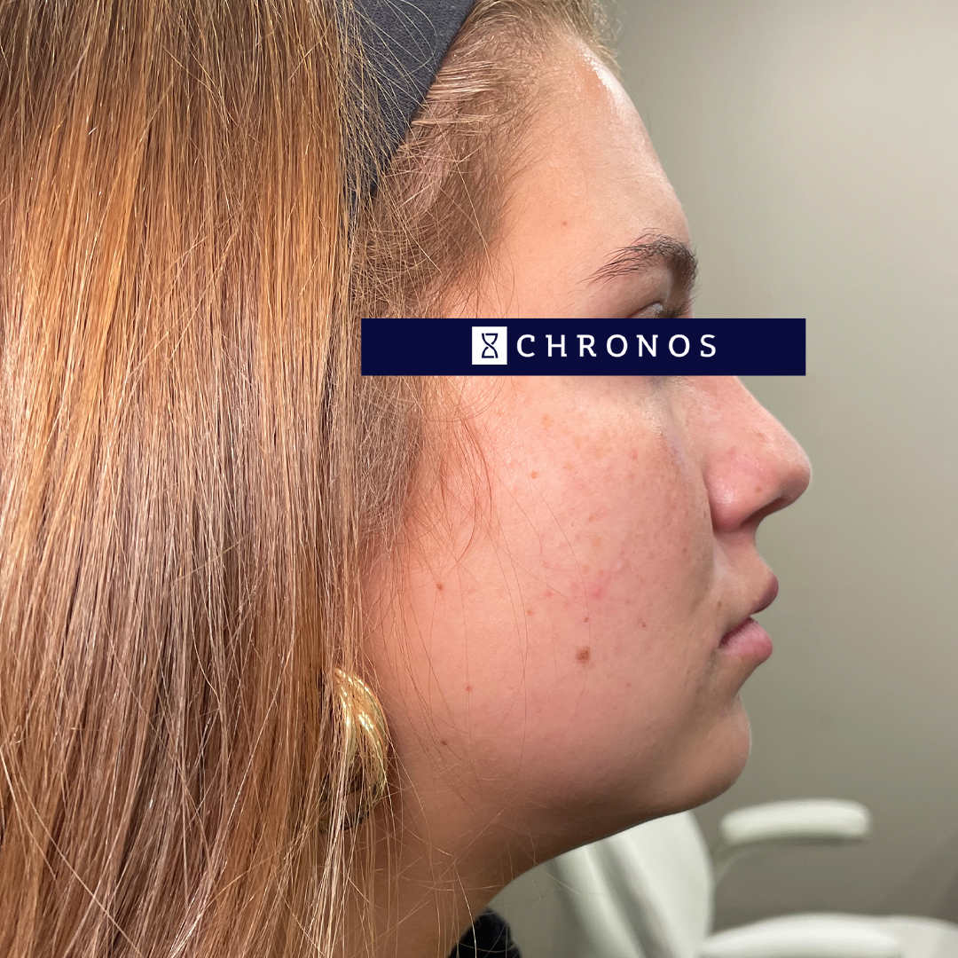 Before photo of jaw and chin dermal filler in Metairie, LA at Chronos BHW