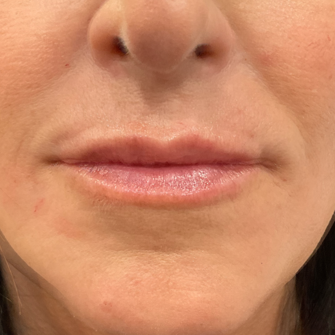 After dermal Lip Filler photo at Chronos Body Health & Wellness in Metairie and New Orleans, LA