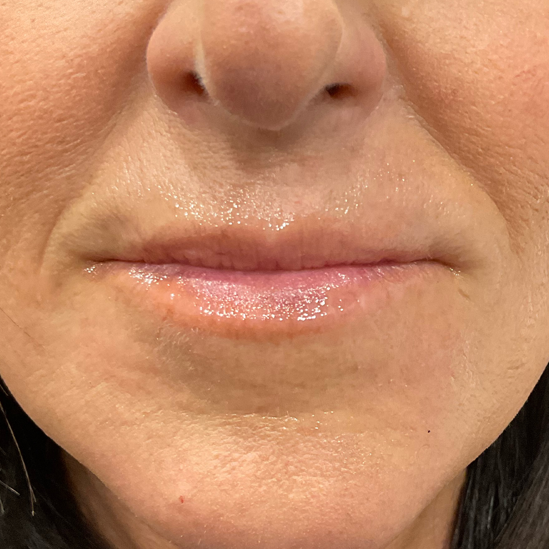 Before Lip Filler photo at Chronos Body Health & Wellness in Metairie and New Orleans, LA