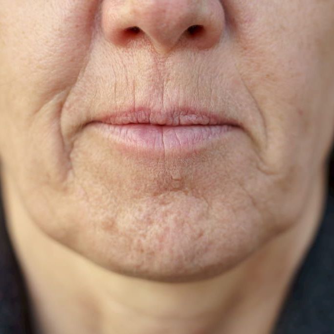 Treat loose skin and sagging skin with treatments at med spa in Metairie | Chronos BHW
