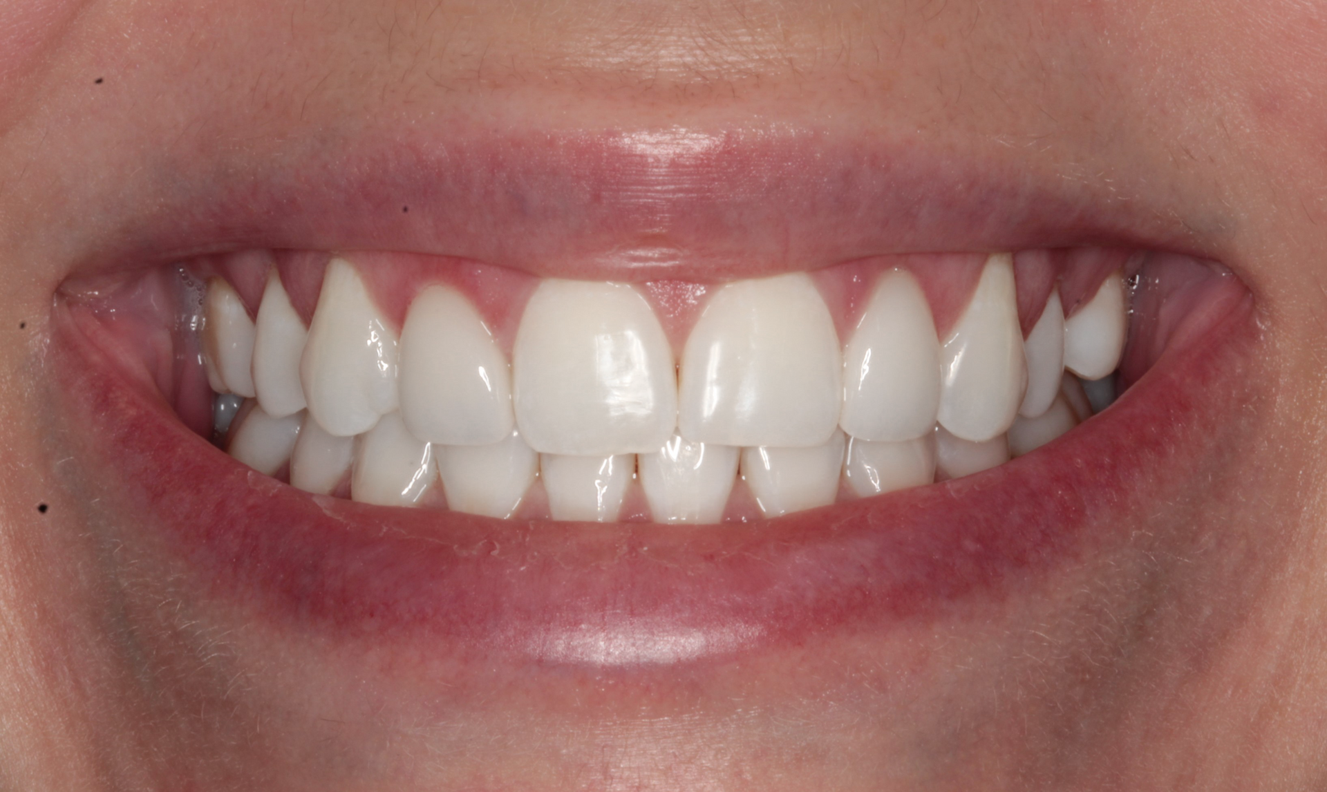 A close up of a woman 's smile with white teeth.