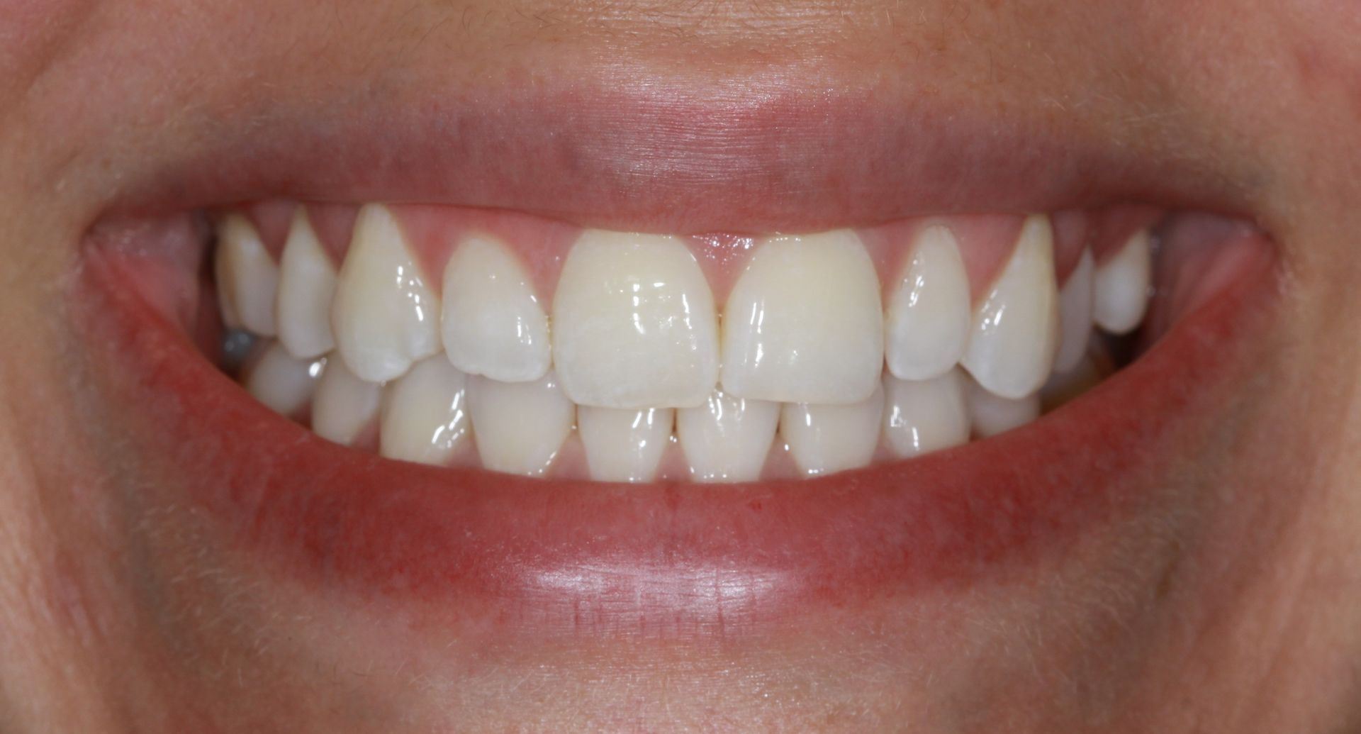 A close up of a woman 's smile with white teeth.