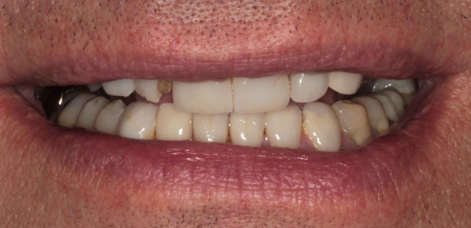 A close up of a man 's teeth with a missing tooth.