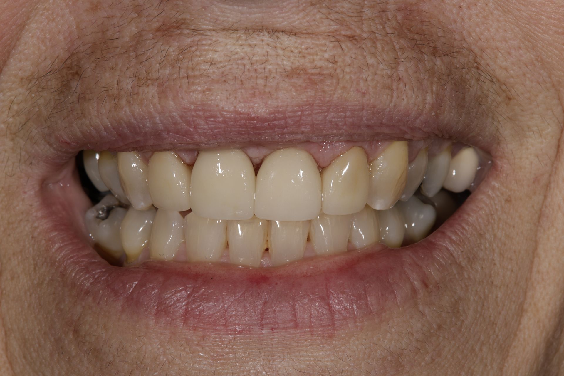 A close up of a person 's teeth with a smile.