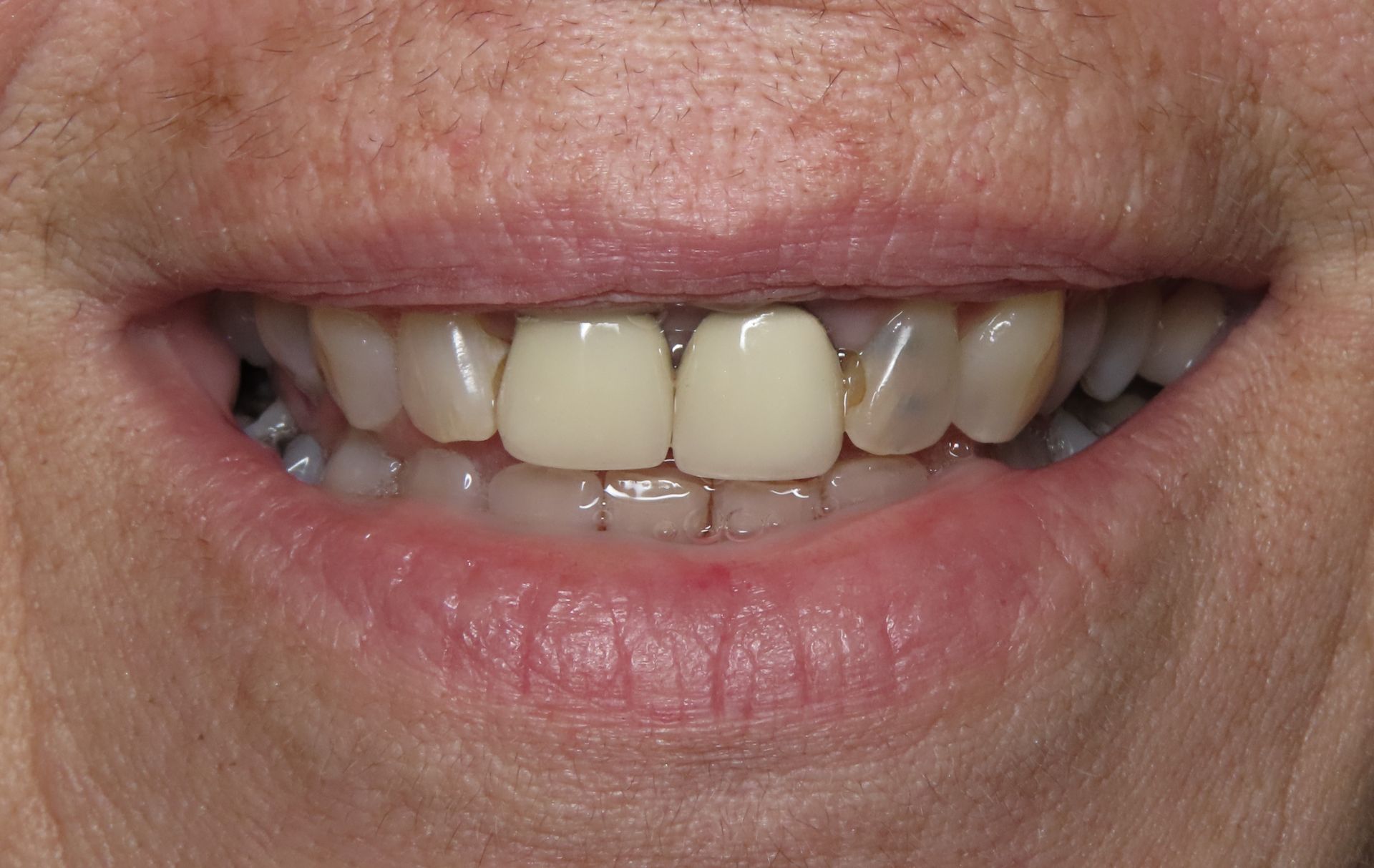 A close up of a woman 's mouth with a crown on her teeth.