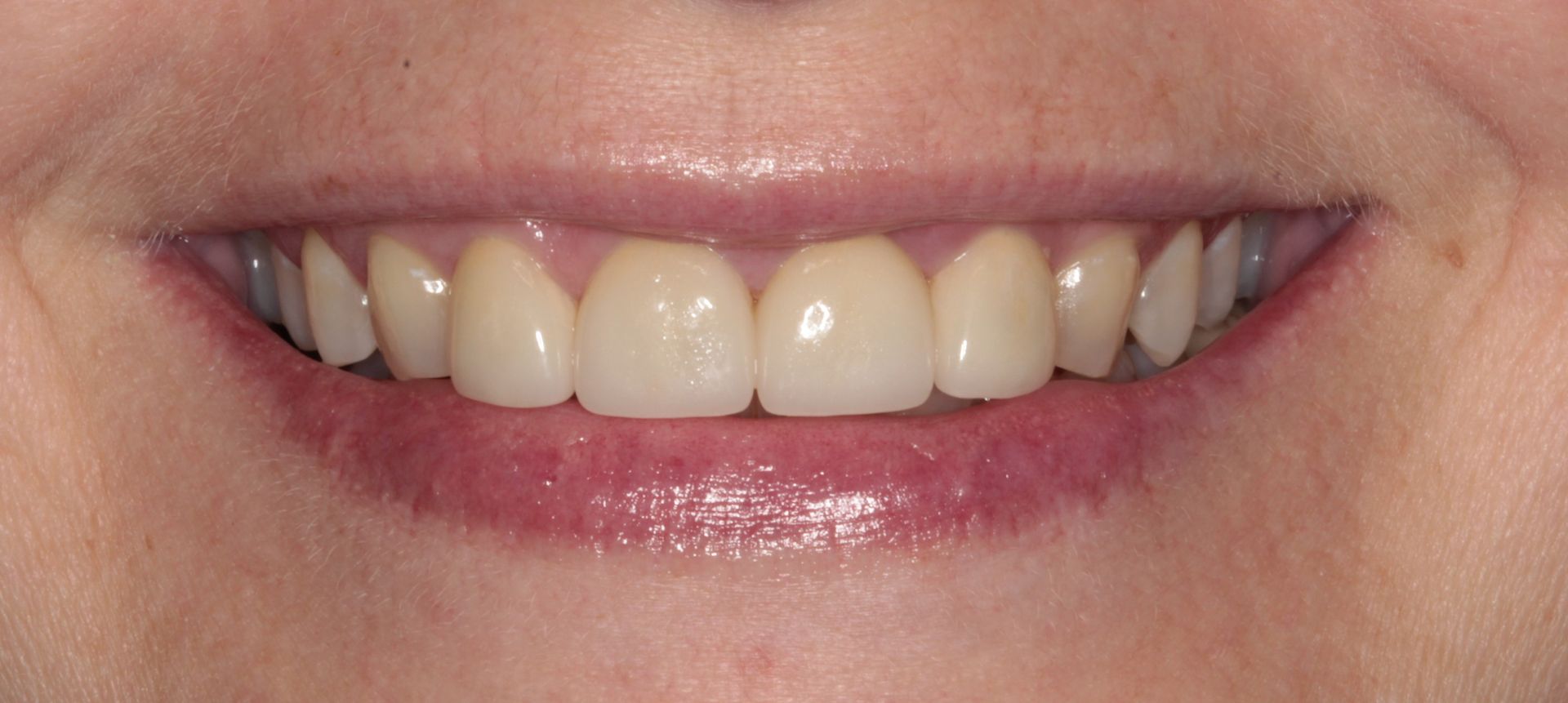 A close up of a woman 's smile with white teeth.