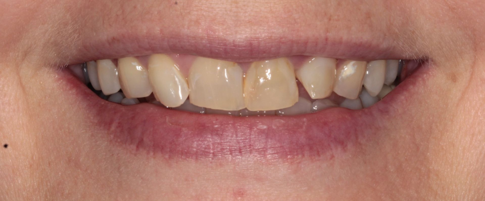 A close up of a woman 's mouth with a broken tooth.