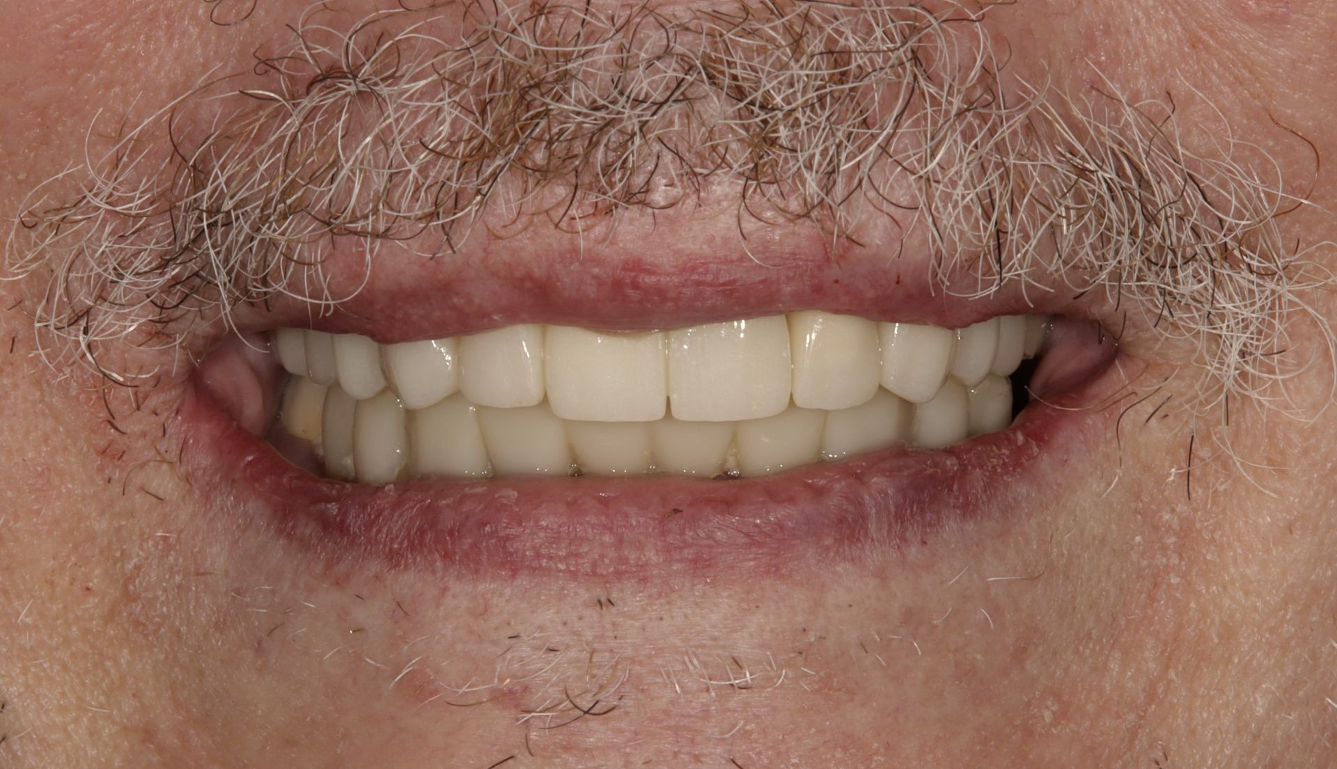 A close up of a man 's mouth with a beard and white teeth.