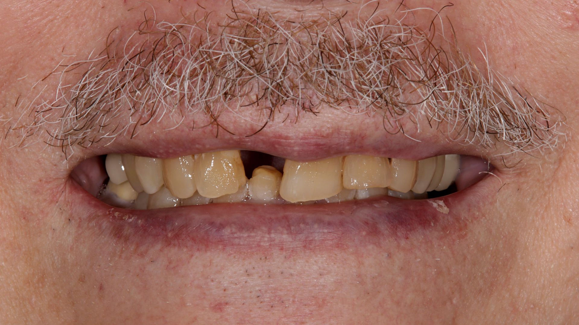 A close up of a man 's mouth with a missing tooth.