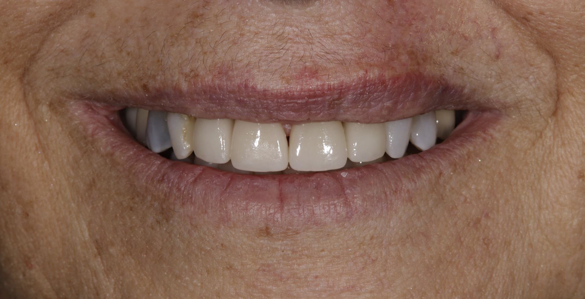 A close up of a woman 's smile with white teeth.