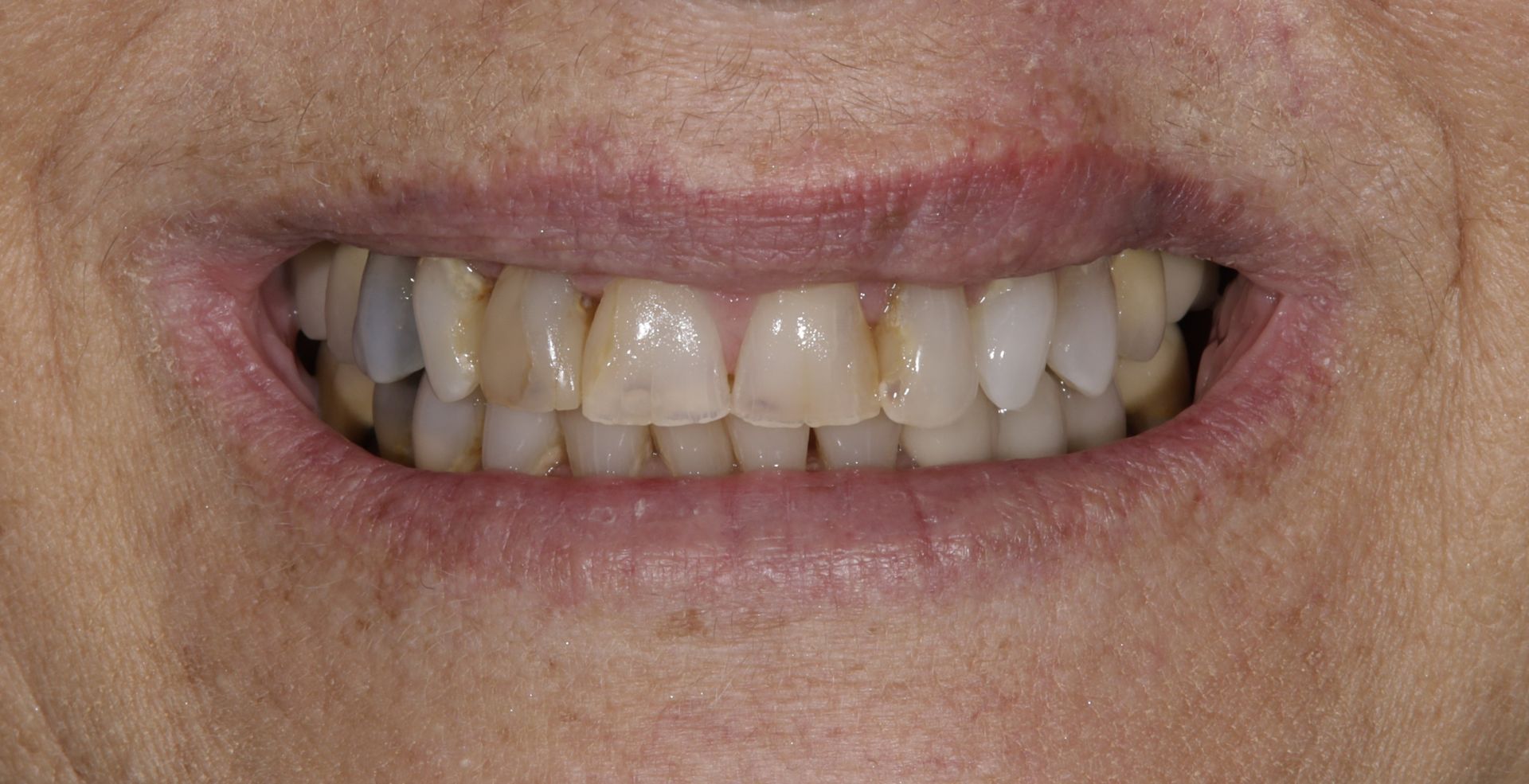 A close up of a person 's teeth with a missing tooth.