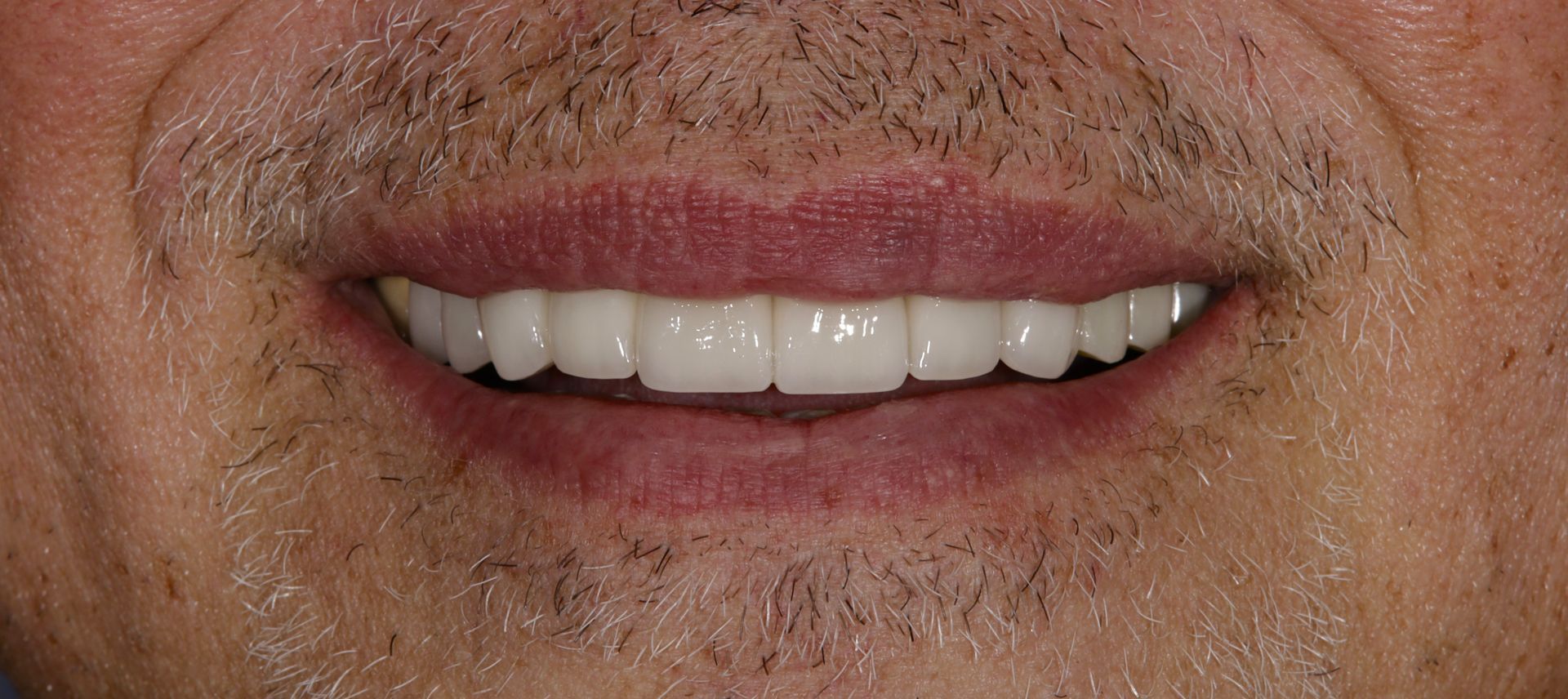 A close up of a man 's mouth with a beard and white teeth.