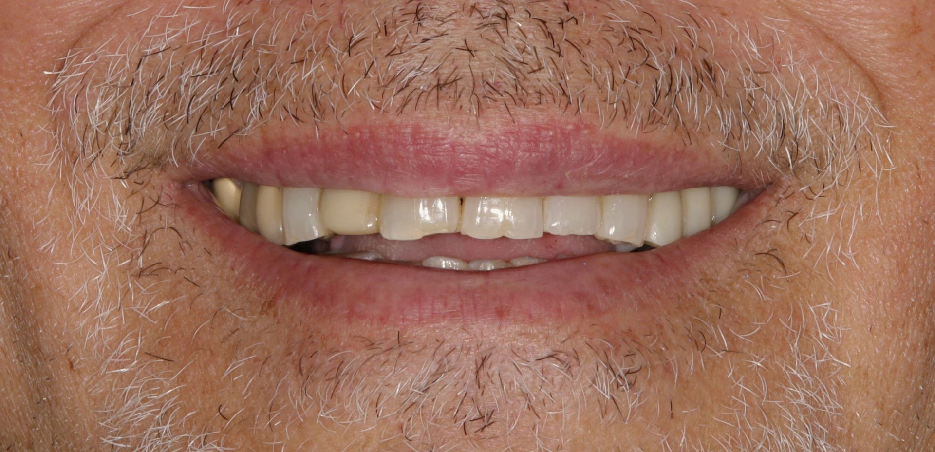 A close up of a man 's mouth with a beard and teeth.