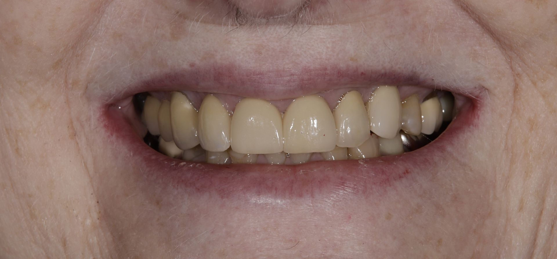 A close up of an elderly woman 's teeth with a smile.