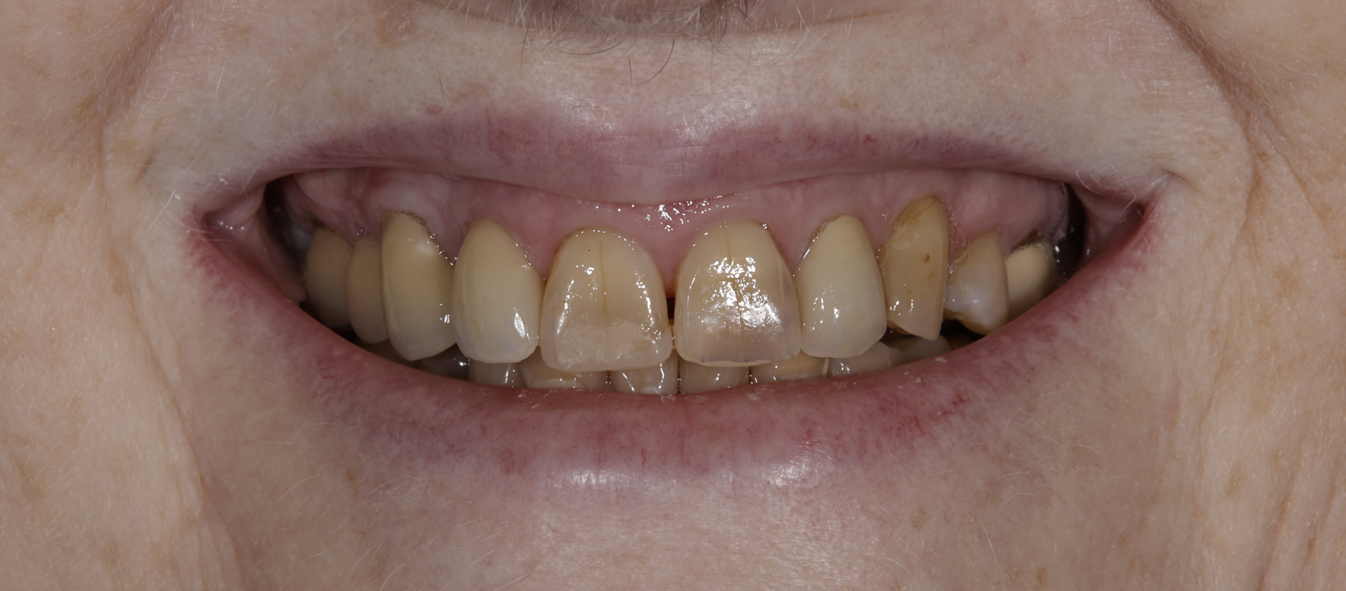 A close up of a person 's mouth with a lot of teeth.