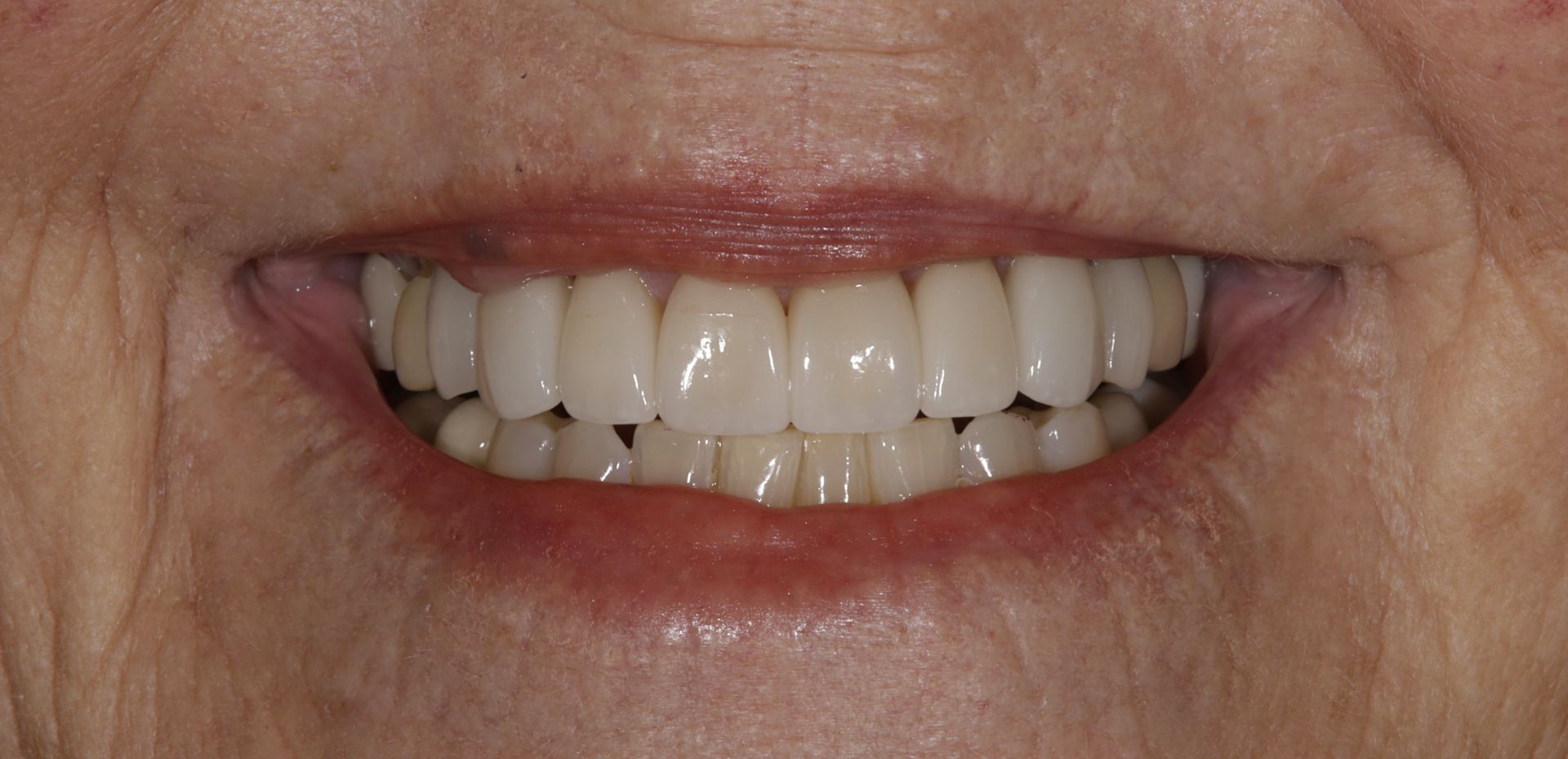 A close up of a woman 's smile with white teeth.