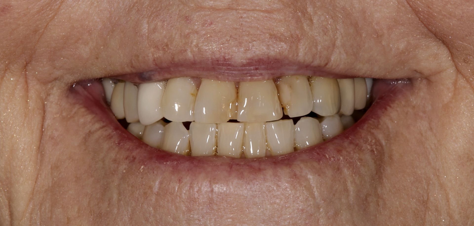 A close up of an elderly woman 's smile with missing teeth.