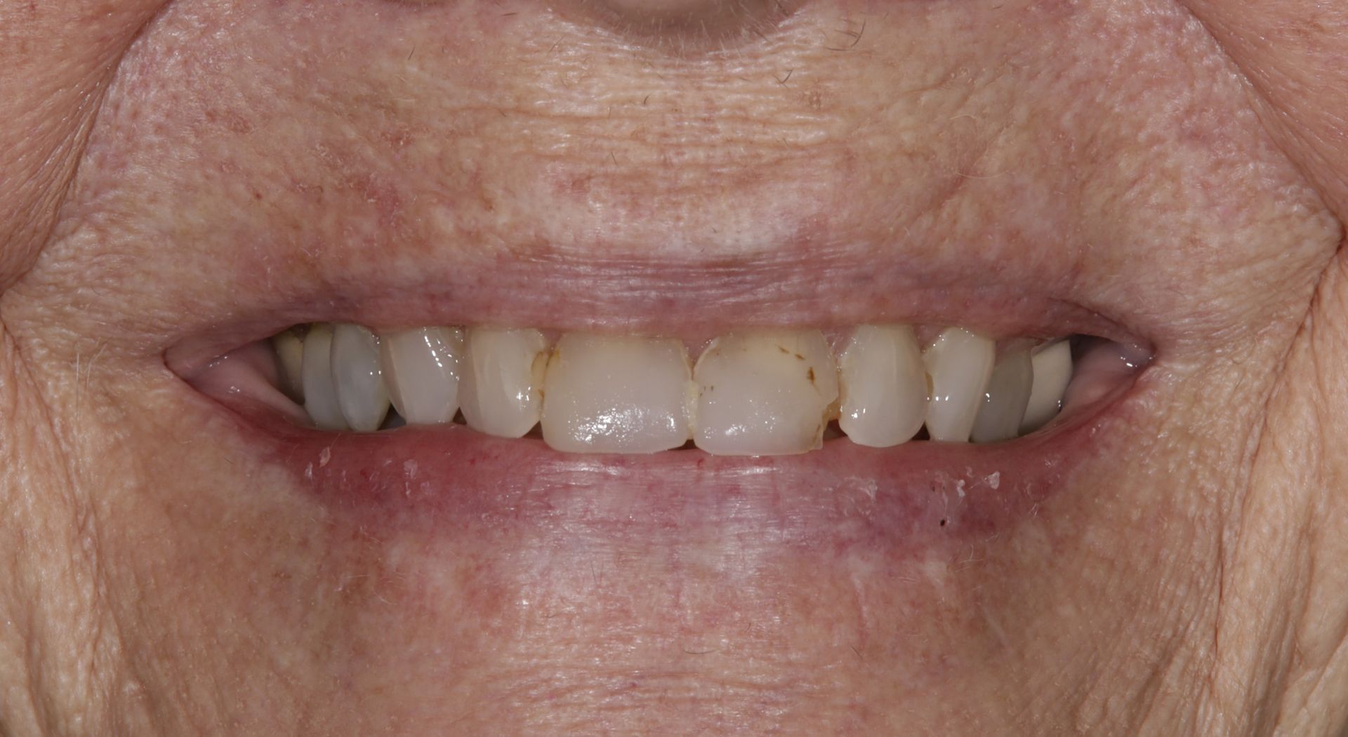 A close up of an elderly woman 's smile with a lot of teeth.