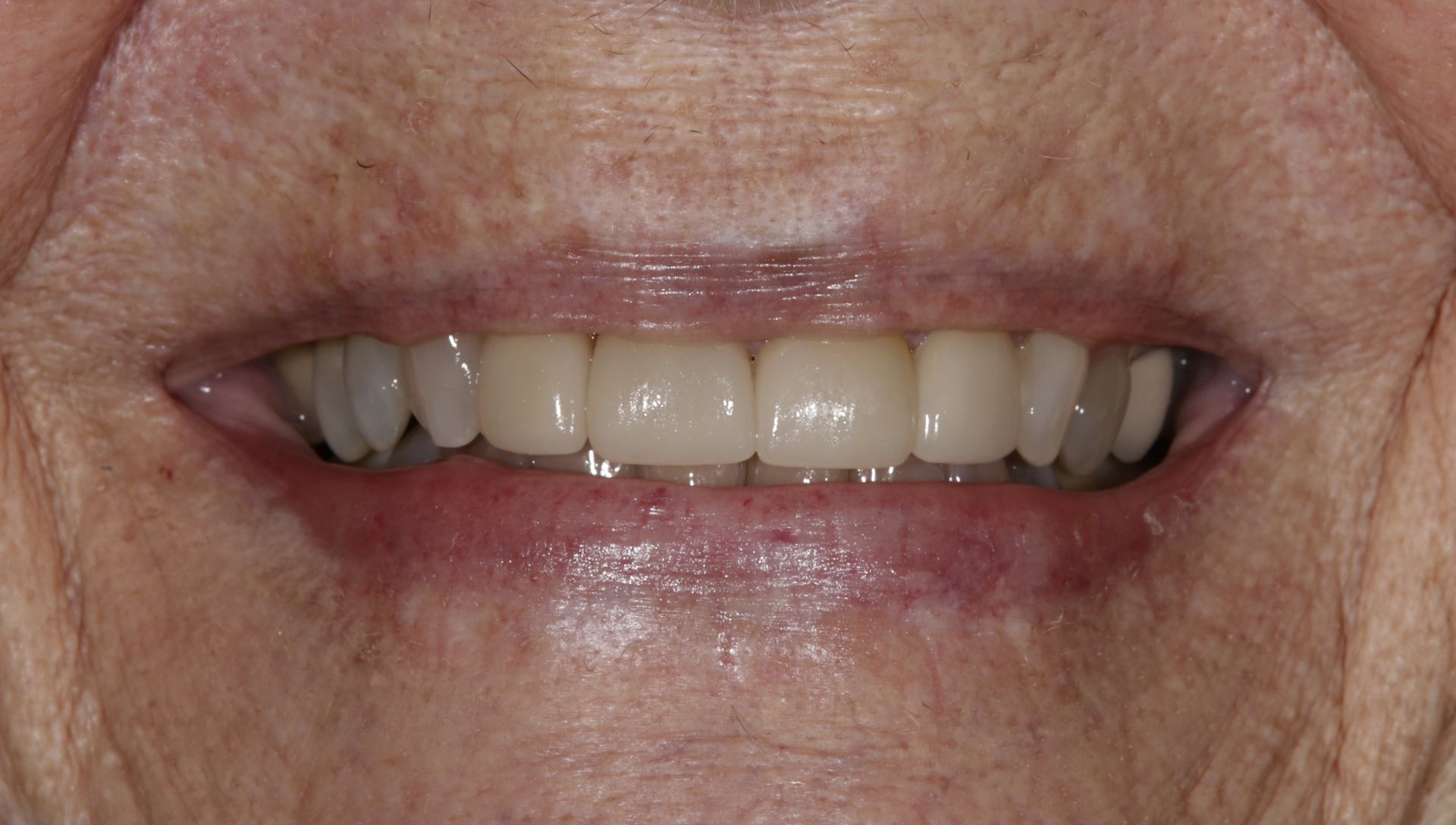 A close up of an elderly woman 's smile with white teeth.