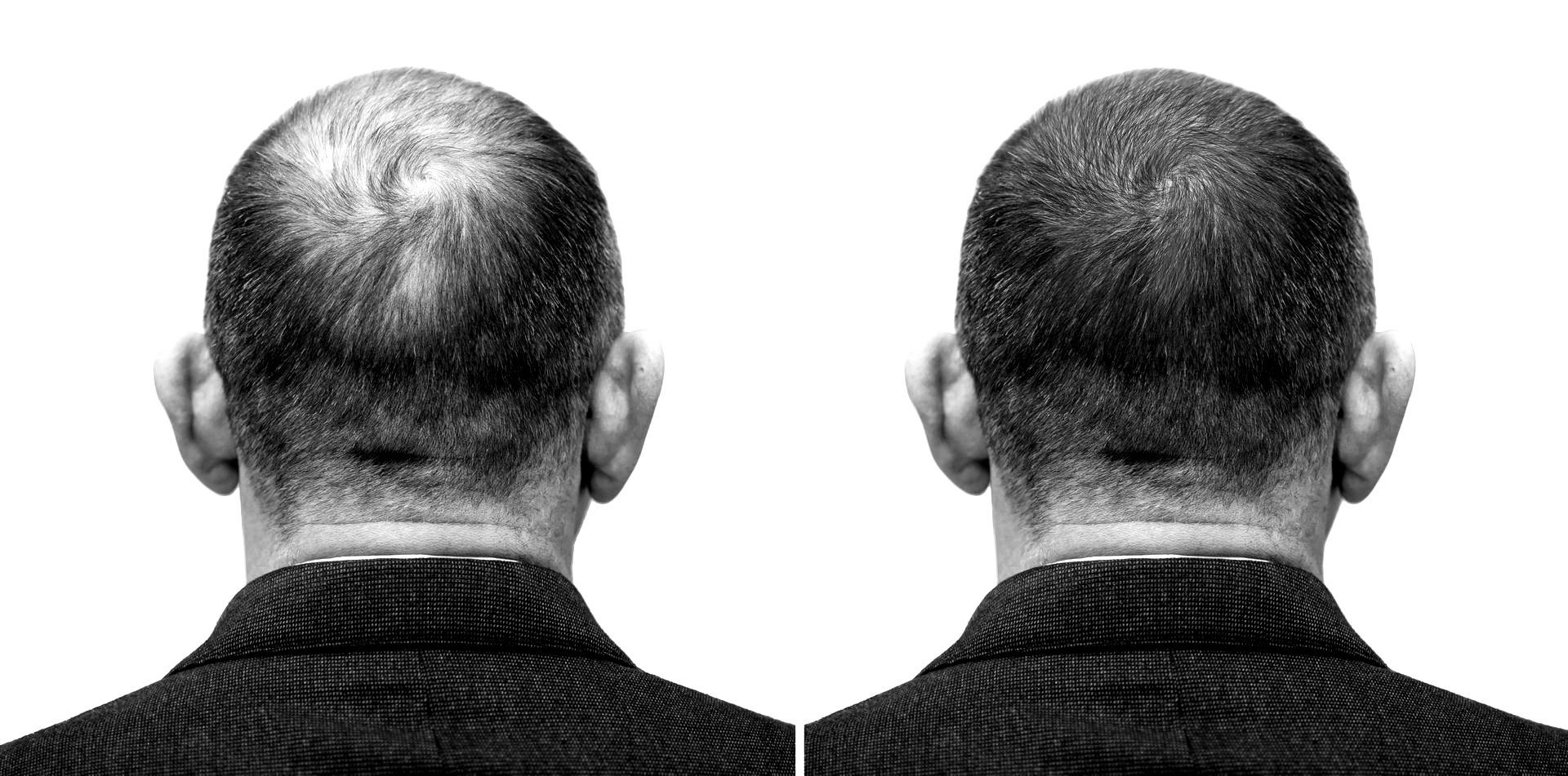 Hair restoration before and after in Plano Texas