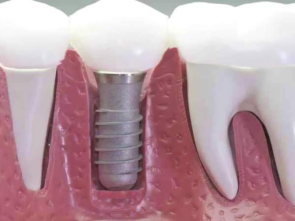 DRA BEATRIZ PALACIOS ZUÑIGA - Implantes Dentales