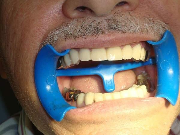 DRA BEATRIZ PALACIOS ZUÑIGA - Restauración dental