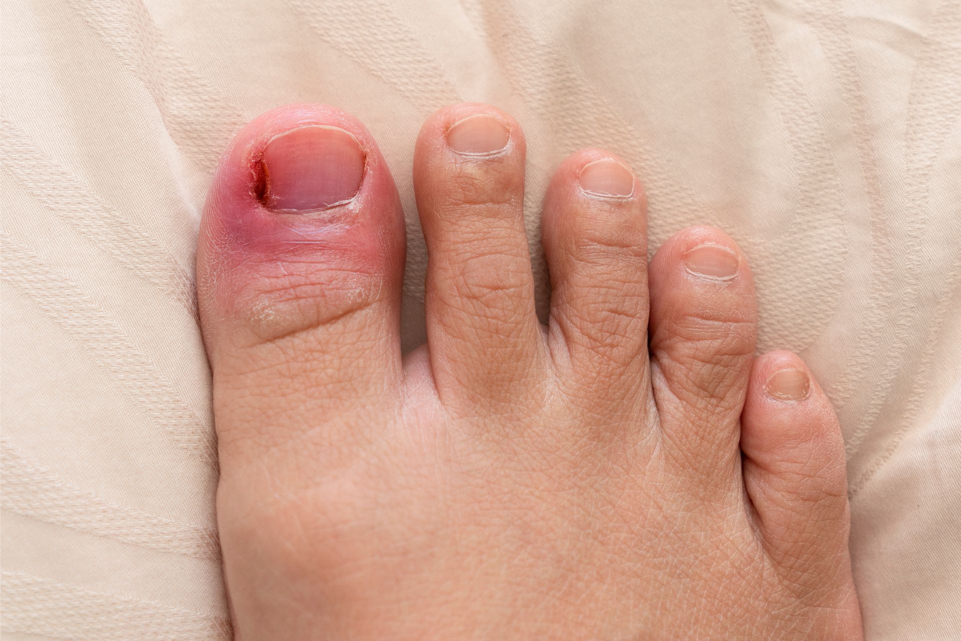 A swollen, infected big toe with red, inflamed skin and a damaged nail on a fabric background