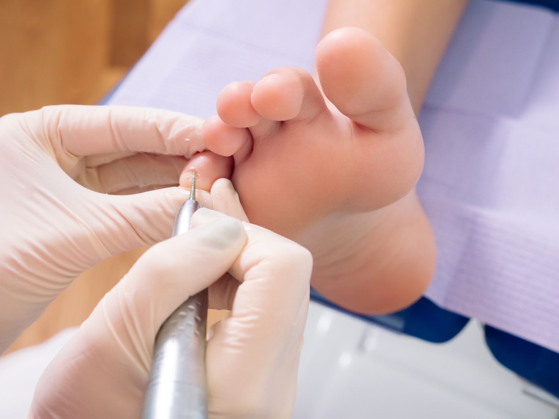 Foot of a patient being treated in the podiatrist consultation.