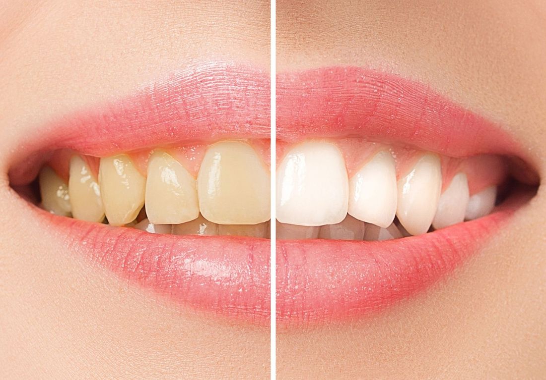 denti prima e dopo il trattamento di igiene dentale