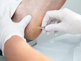 MANEJO AVANZADO DE ÚLCERAS Y PIE DIABÉTICO