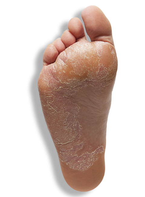 MANEJO AVANZADO DE ÚLCERAS Y PIE DIABÉTICO