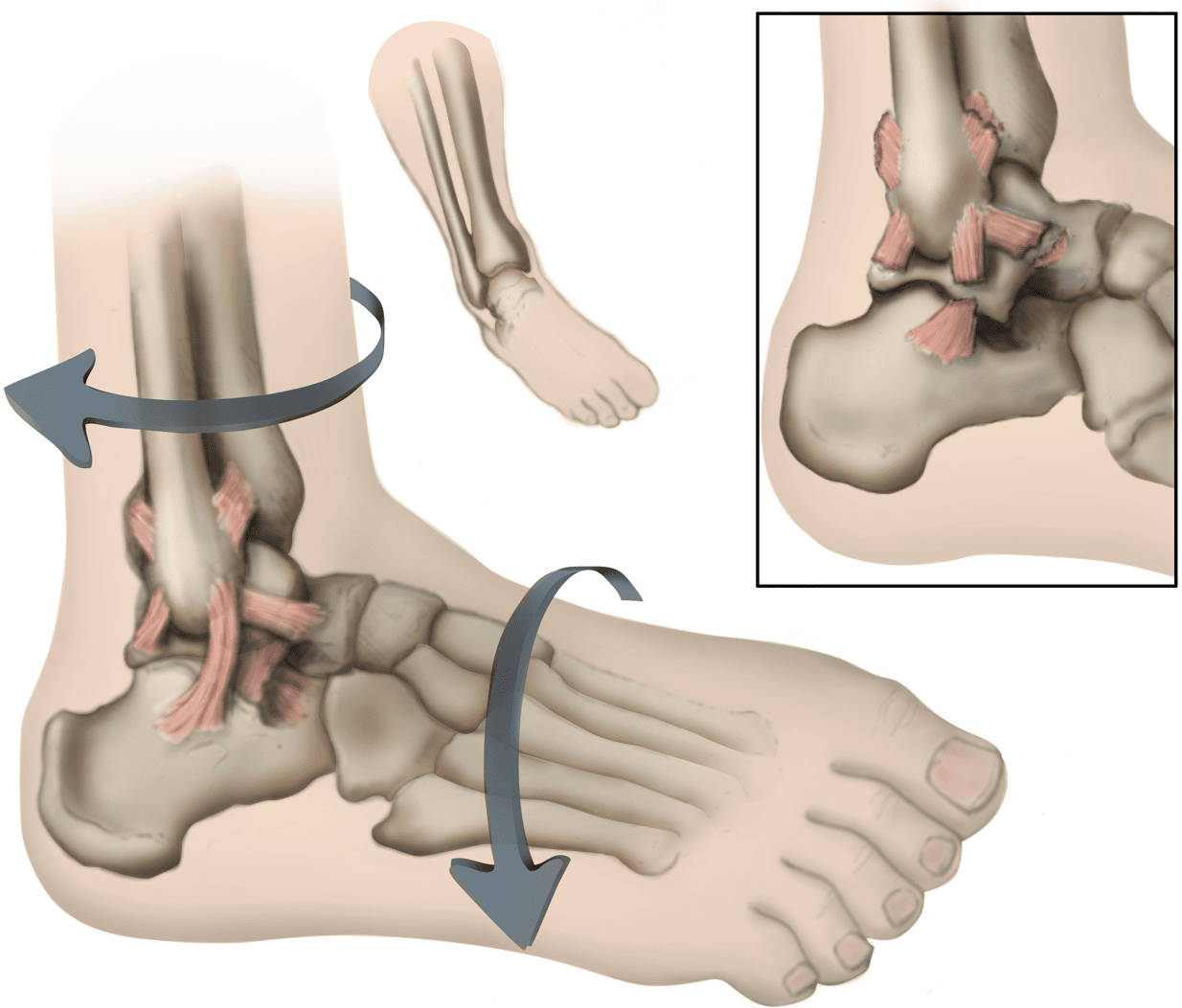 What is Ankle Instability? Symptoms, Causes, Diagnosis