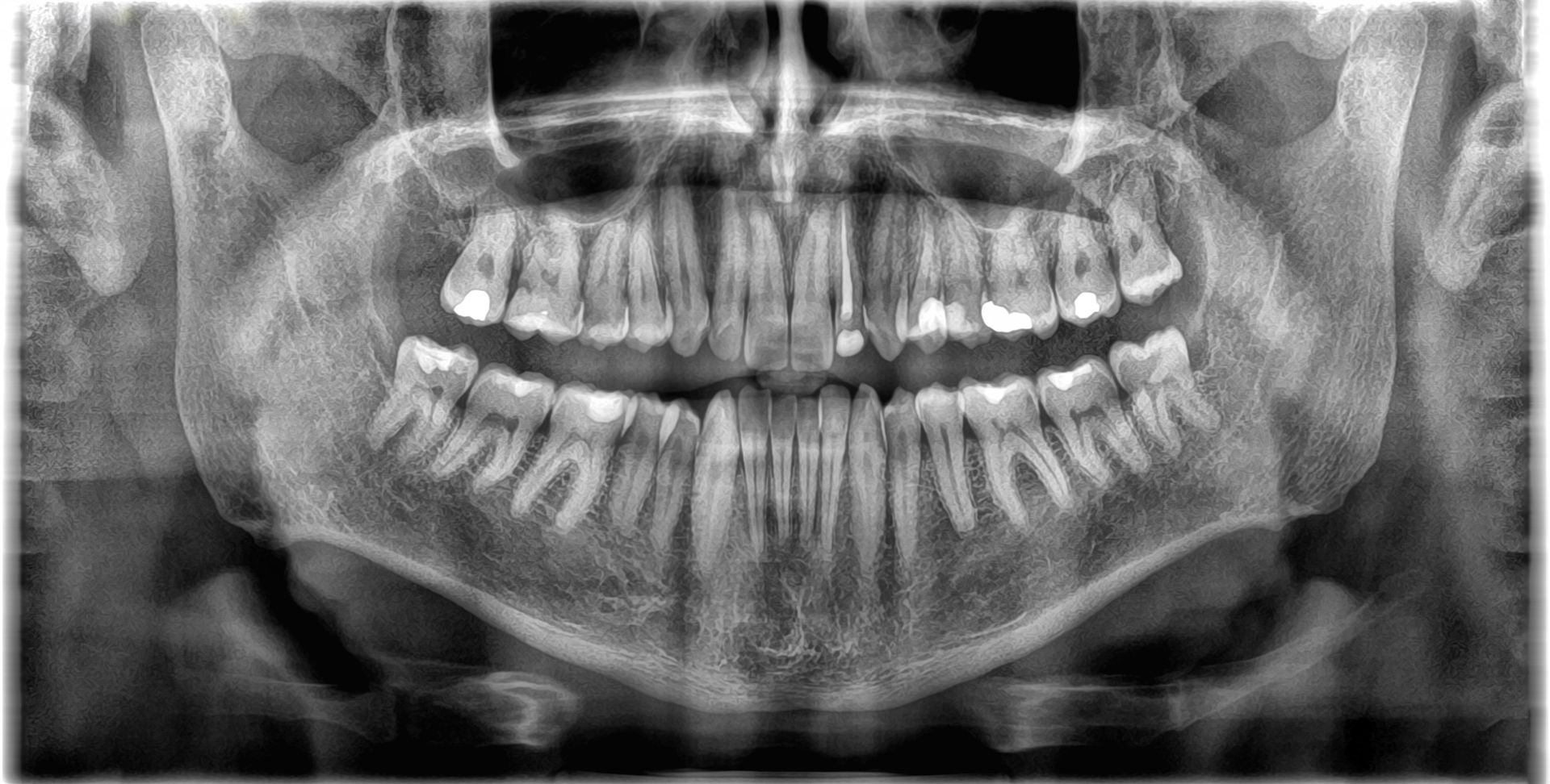 A black and white x-ray of a person 's teeth.