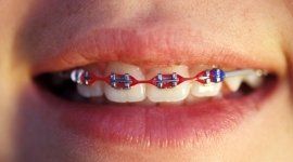 apparecchi ortodontici