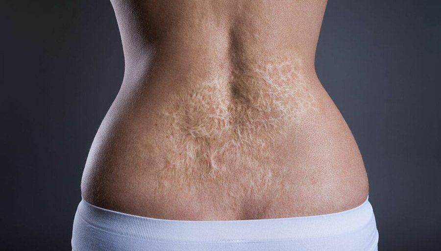 Stockton Burn Injury Attorney