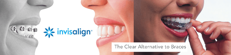 Clear Invisalign to Braces — Hobart, TAS — Moonah Dental Centre