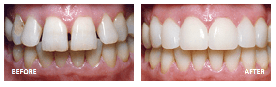 Veneers Before and After — Hobart, TAS — Moonah Dental Centre