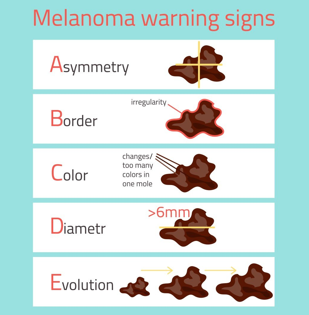 forme del melanoma