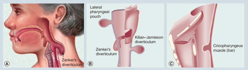 Illustration of Zenker's Diverticulume, Killian-Jamieson diverticulum and cricopharyngeal bar