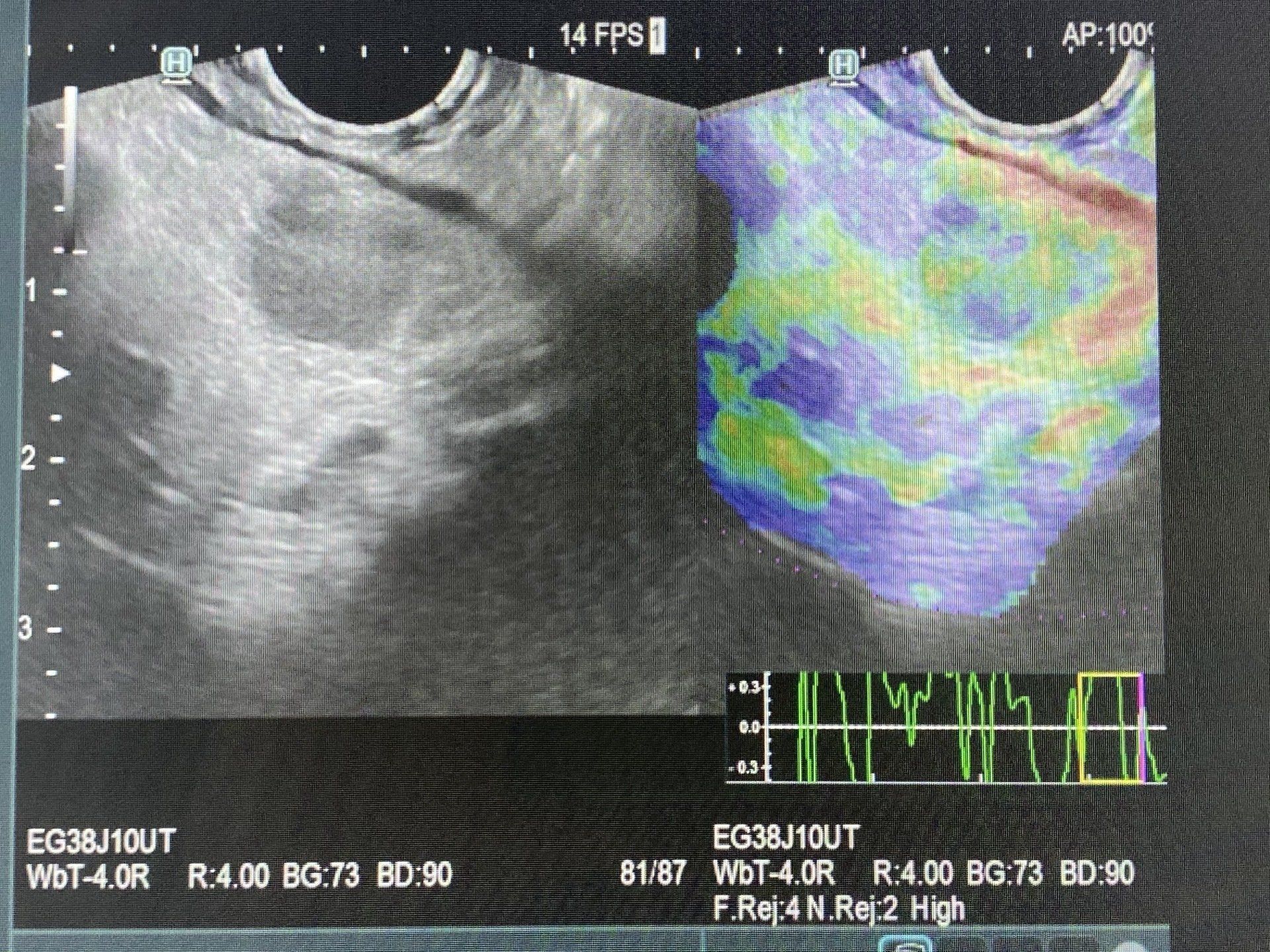 EUS Elstrography image