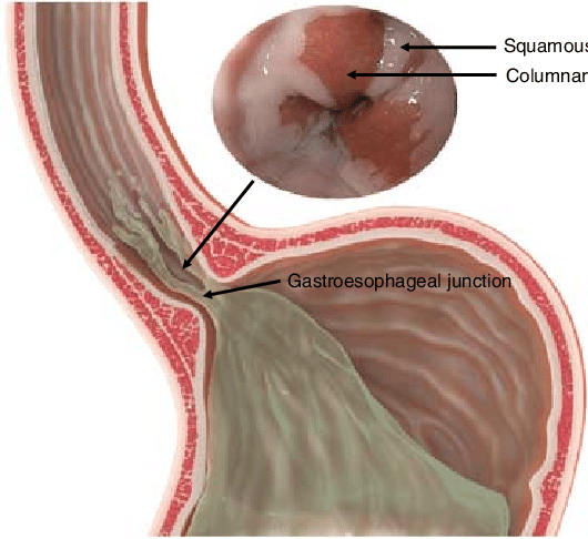 gerd-barrett-s-esophagus