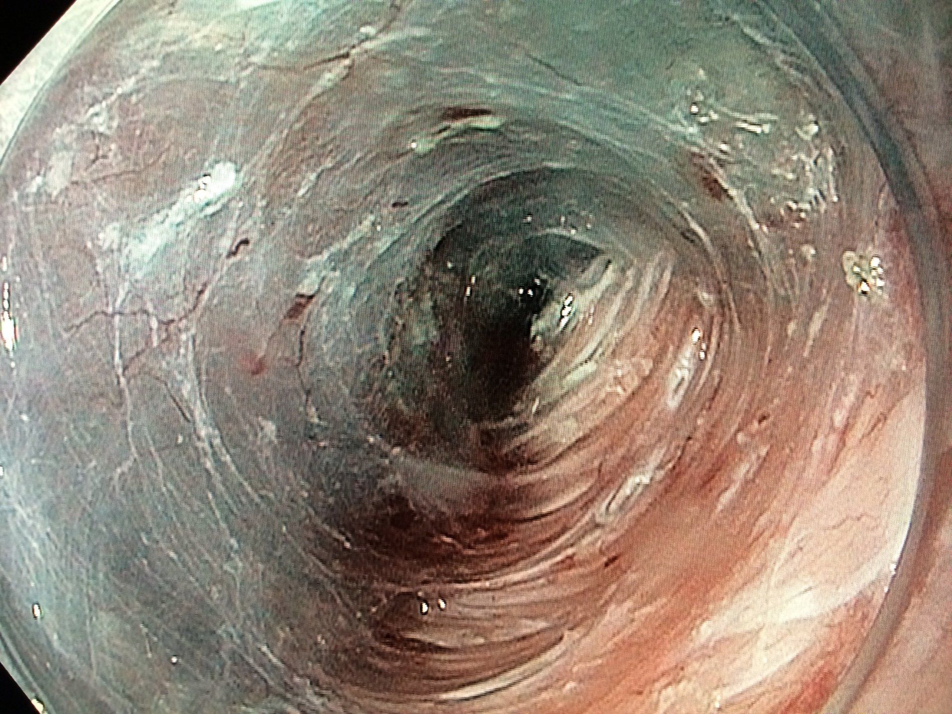 POEM Procedure, Endoscope image
