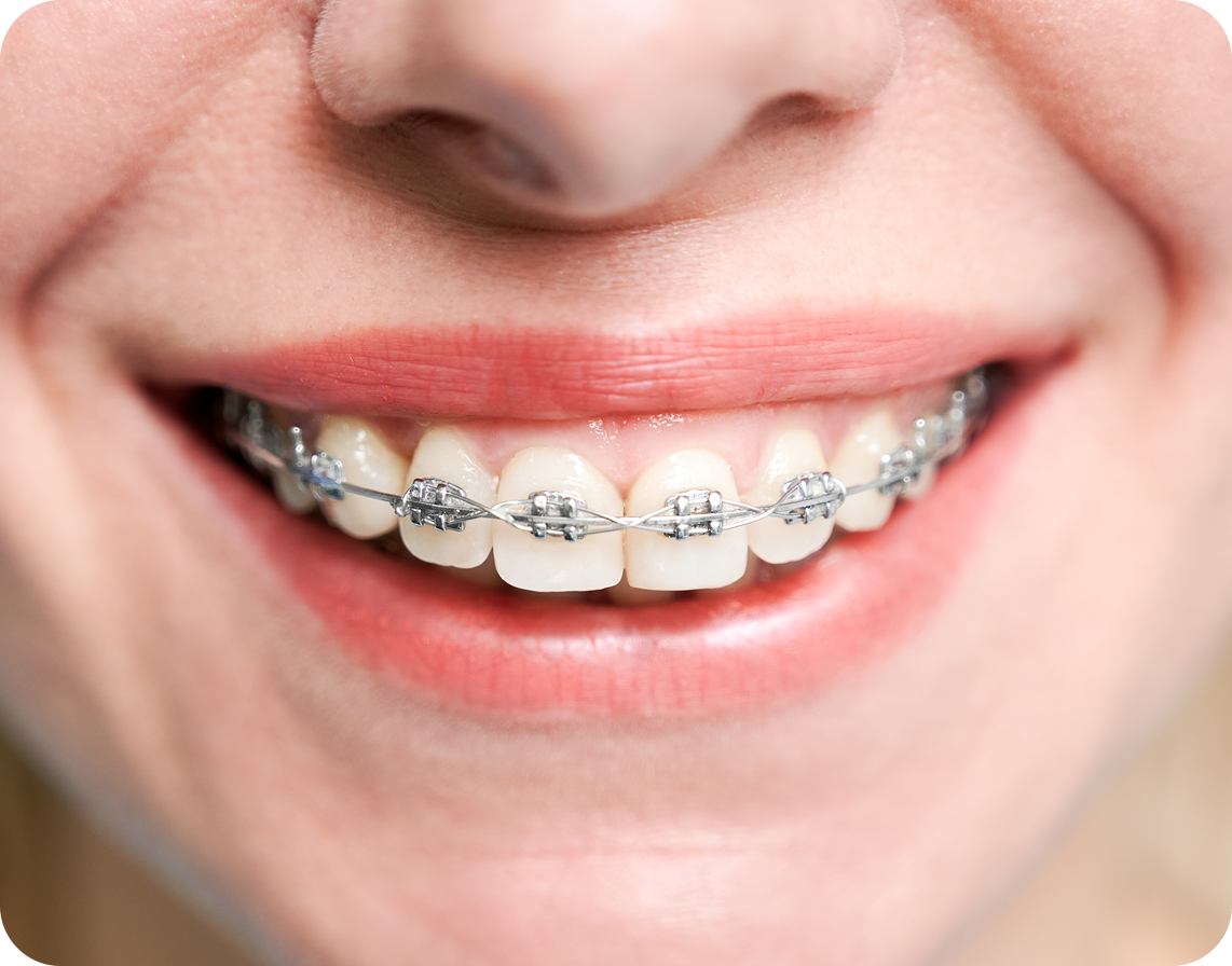 A close-up view of a smiling mouth featuring metal dental braces on the top teeth.