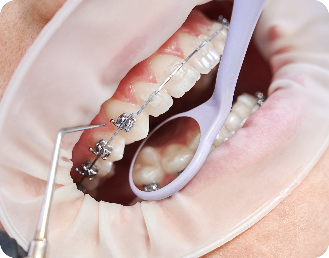 A orthodontist uses a dental mirror and a probe to examine teeth fitted with metal braces.