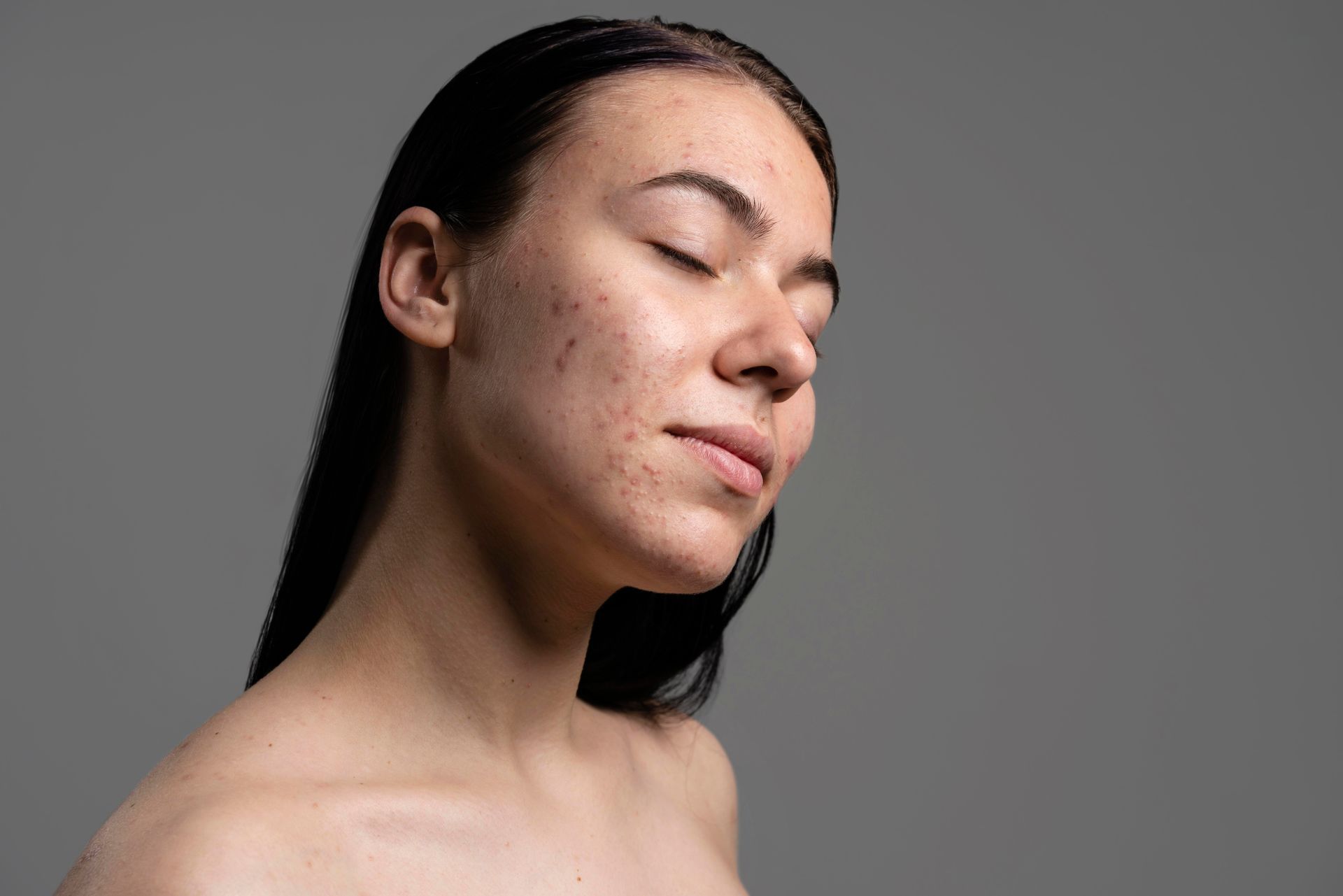 A woman with acne on her face is looking down with her eyes closed.