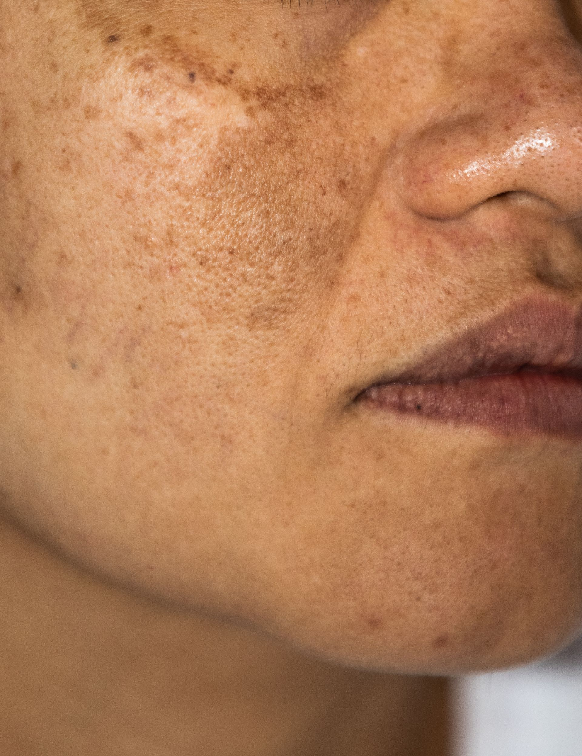 a woman with pigmentation on her face.
