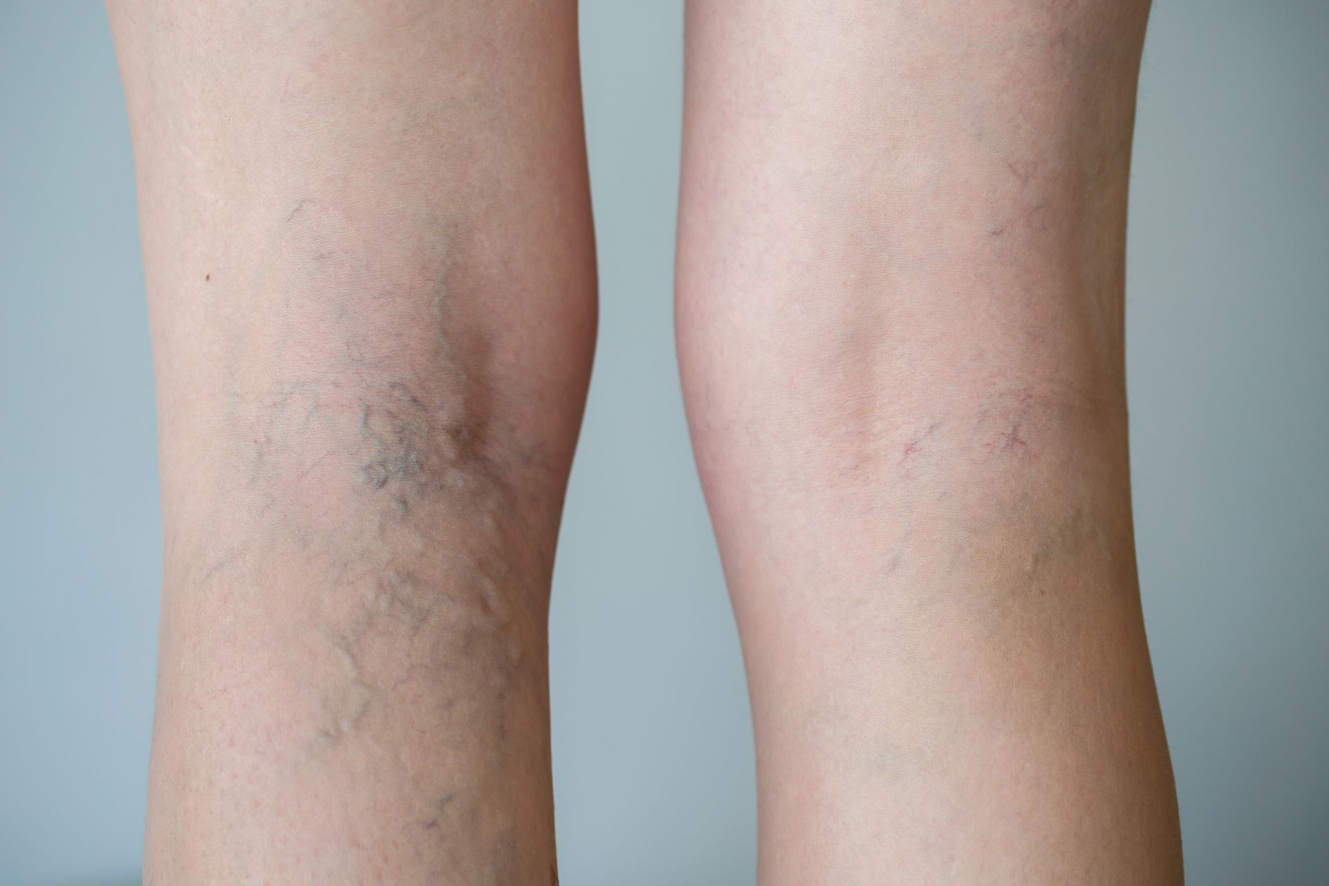 legs with varicose veins.