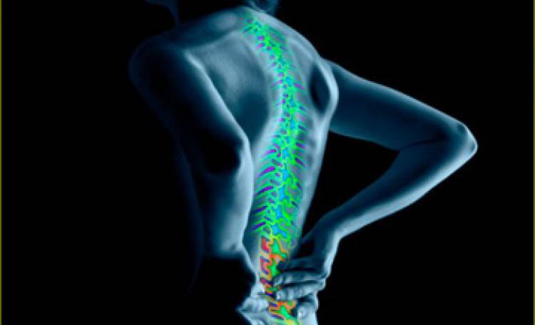 Una donna soffre di dolori alla schiena a causa della spina dorsale.