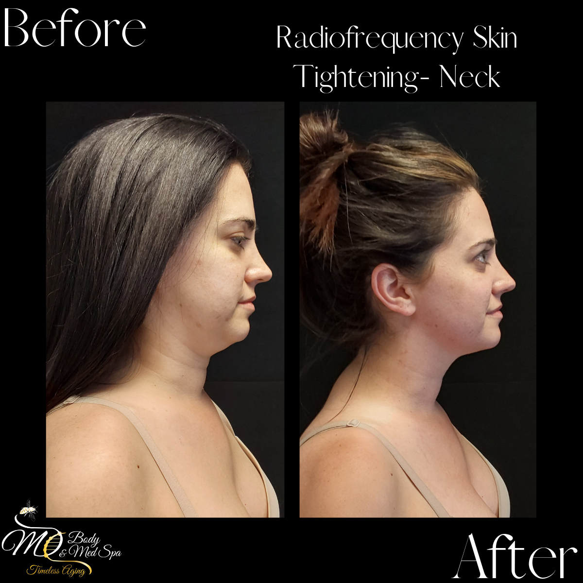 Side-by-side comparison shows radiofrequency skin tightening on the neck.