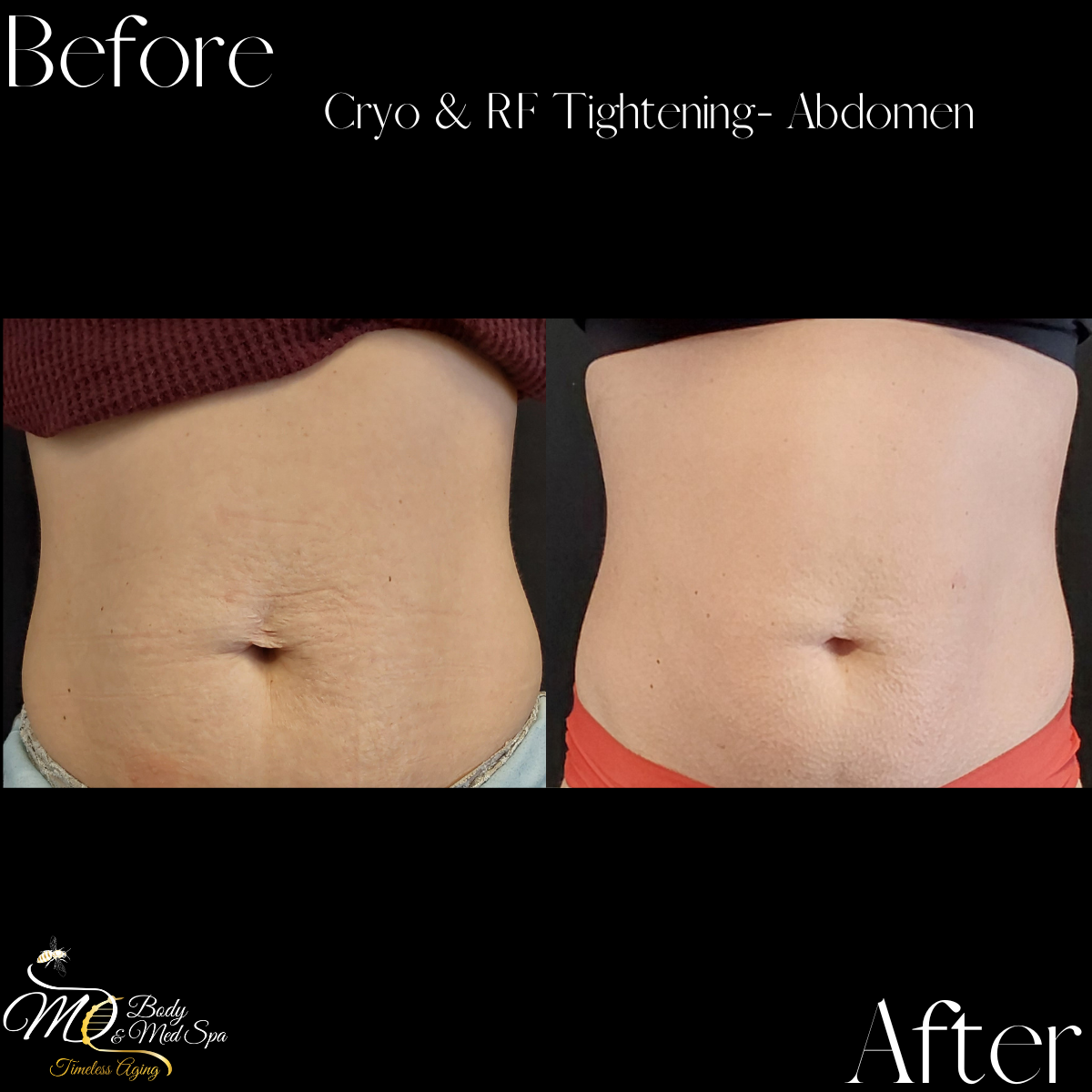 Abdomen comparison after Cryo & RF tightening. Left: before, skin with lines. Right: after, smoother skin.